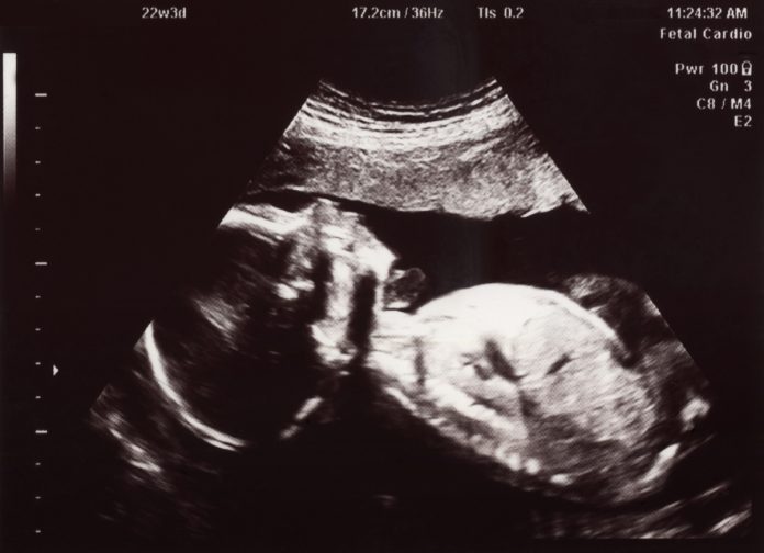 Ultrasound of In Utero Baby at 22 Weeks